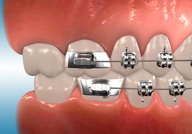 Orthodontic Class II