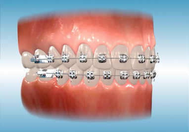 Orthodontic Class II