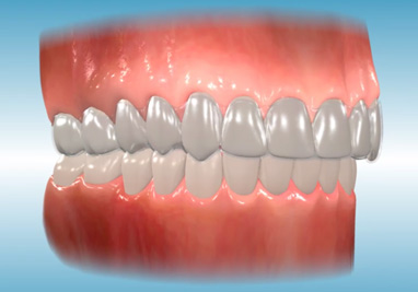 Orthodontic Class II