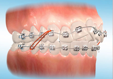 Orthodontic Class II