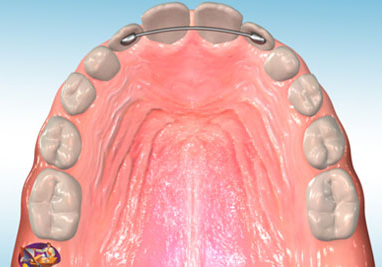 Orthodontic Class II