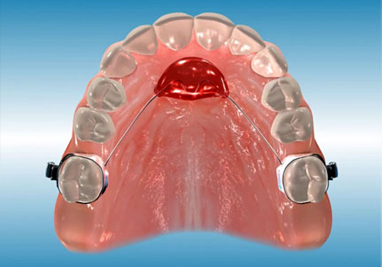 Orthodontic Class II