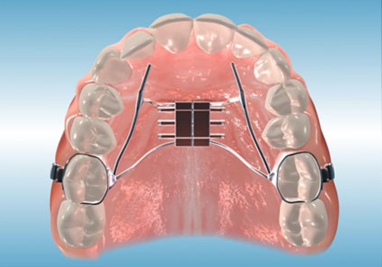 Orthodontic Class II