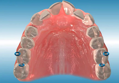 Orthodontic Class II