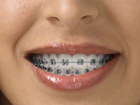 Orthodontic Class II