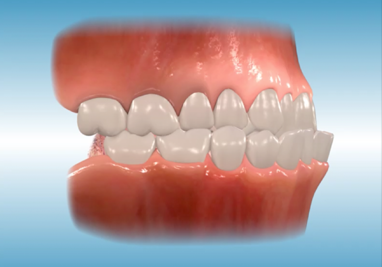 Orthodontic Class III