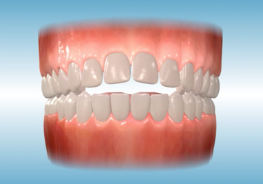 Orthodontics Openbite