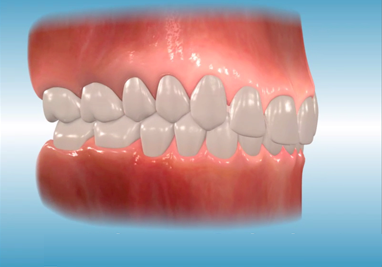 Orthodontics Incisor Overbite