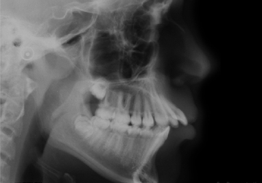 Orthodontic Class II