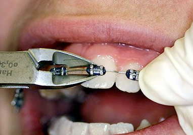Orthodontic Class II