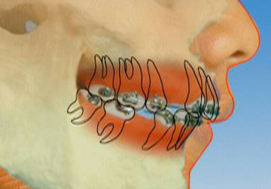 Orthodontic Class II