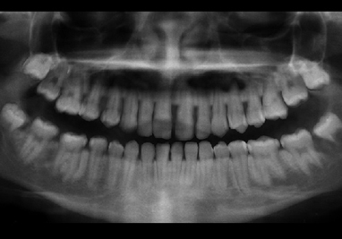 Orthodontic Class II