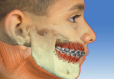 Orthodontic Class II